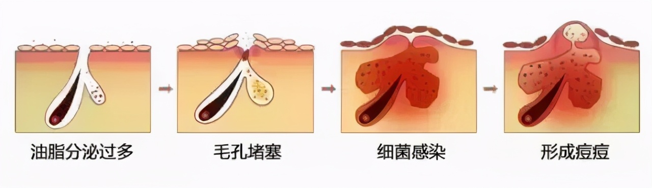 豆尚：红痘印变黑痘印(图2)
